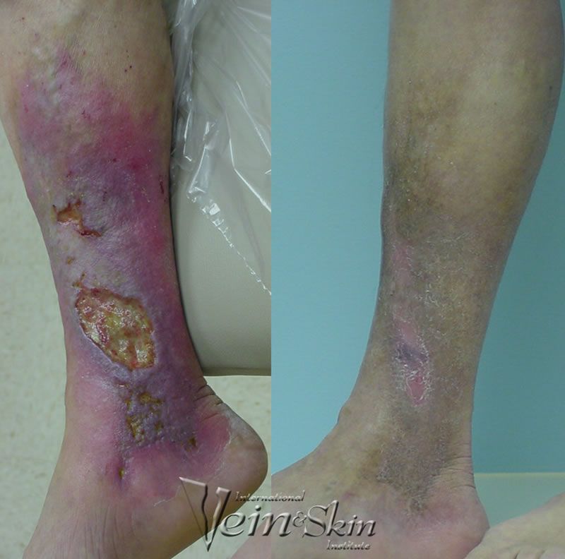 Leg Ulcers - Before and After