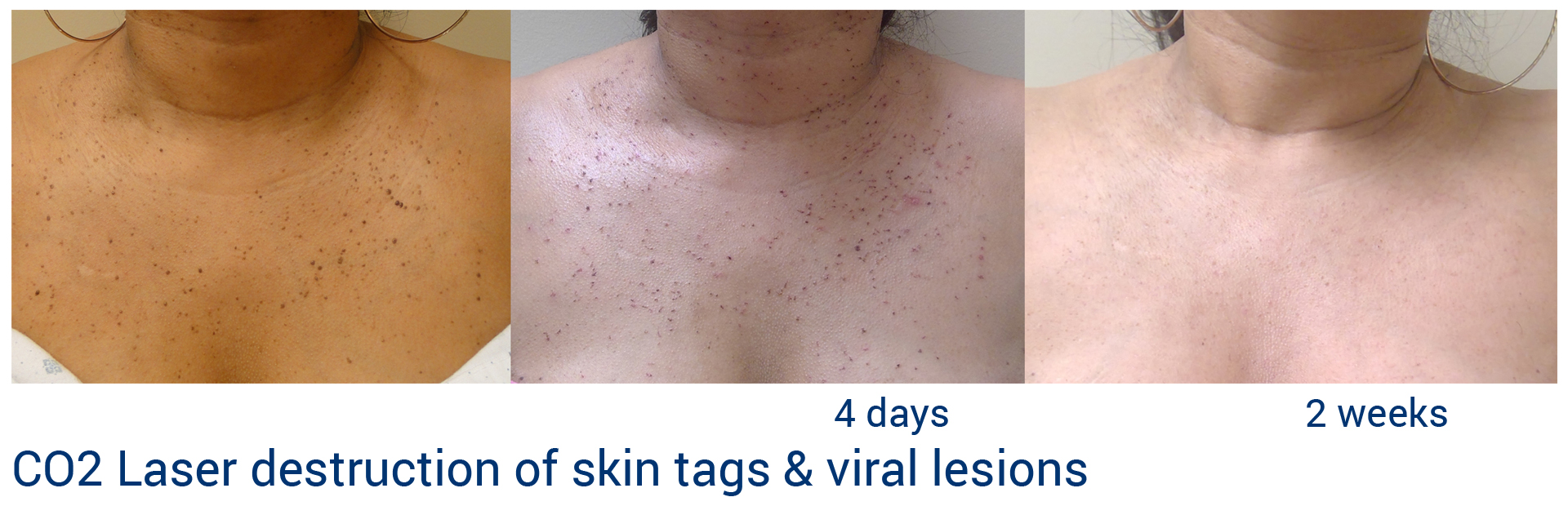 Skin tag removal laser